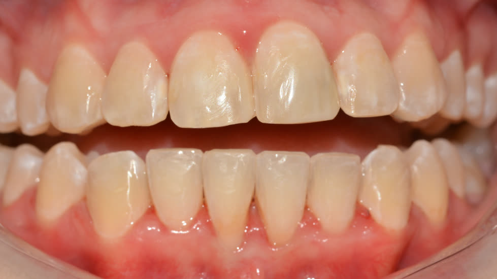 Case 1: after