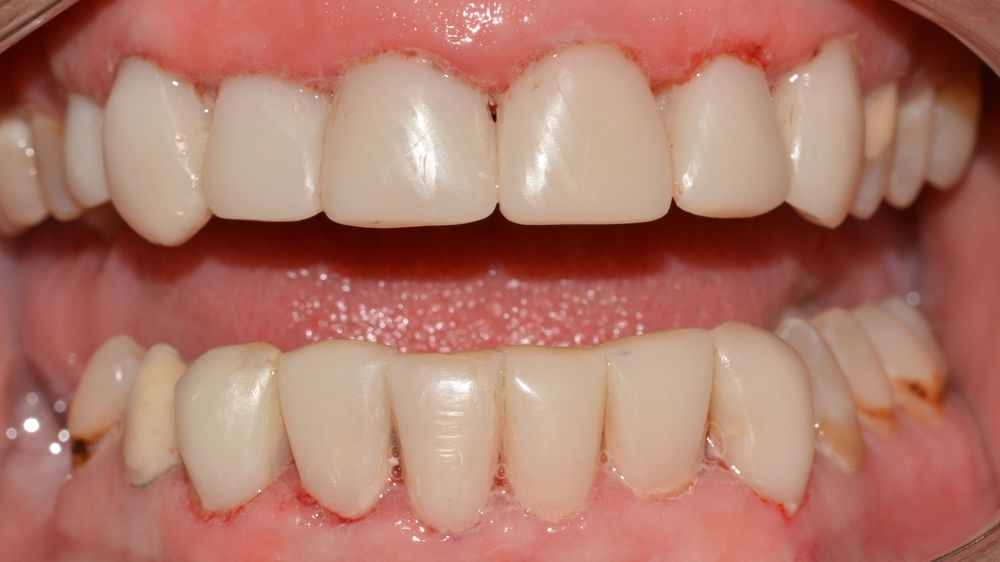 Case 4: after