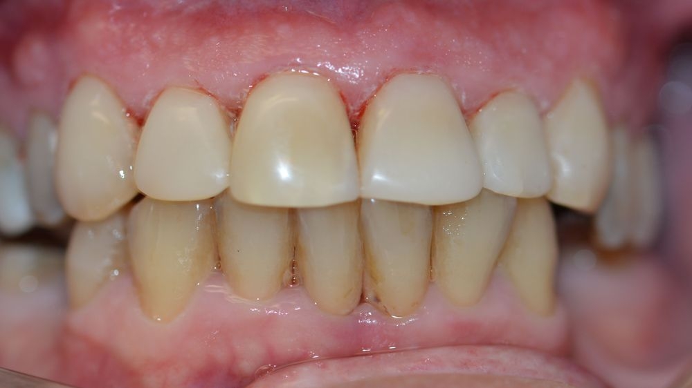 Case 5: after