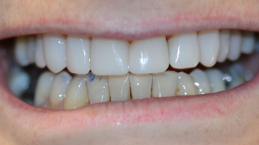 Case 6: after
