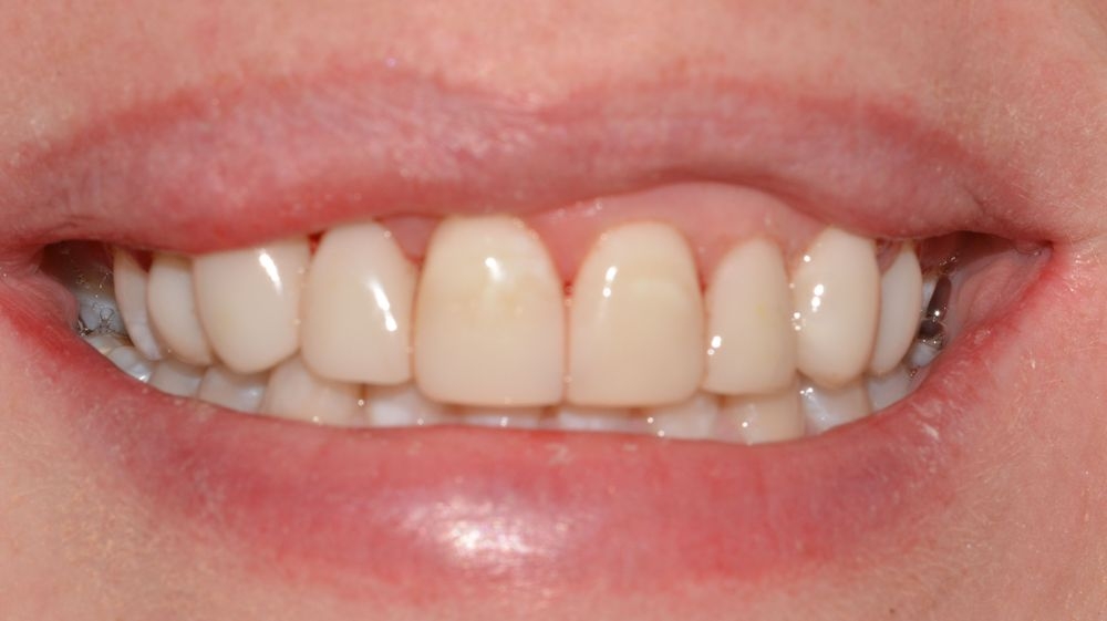 Case 7: after