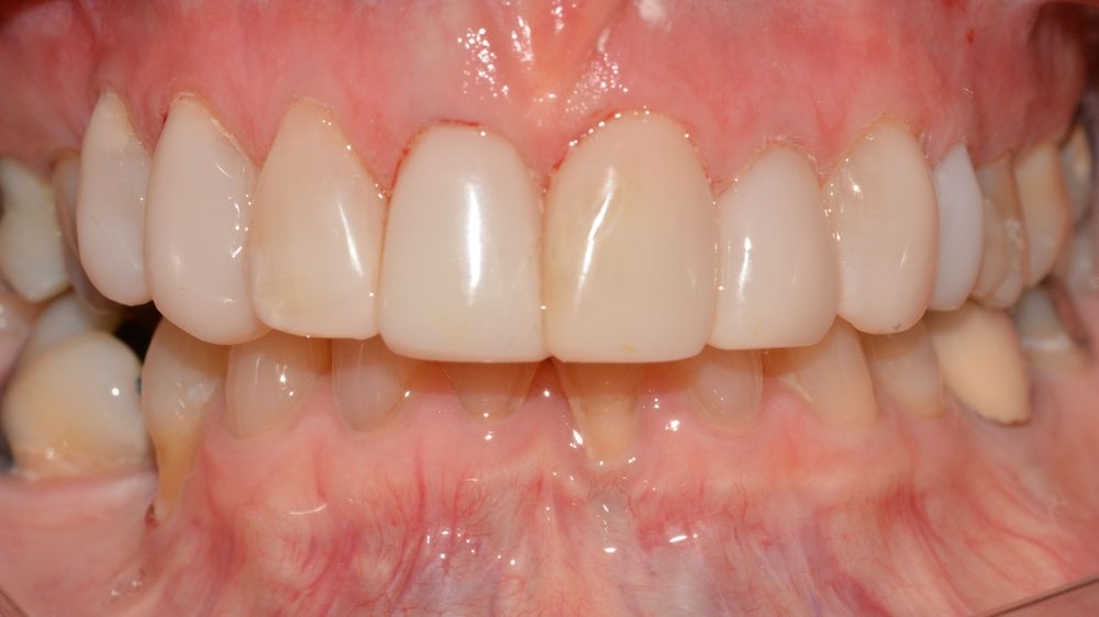 Case 10: after
