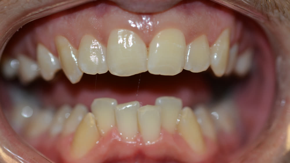 Case 11: before