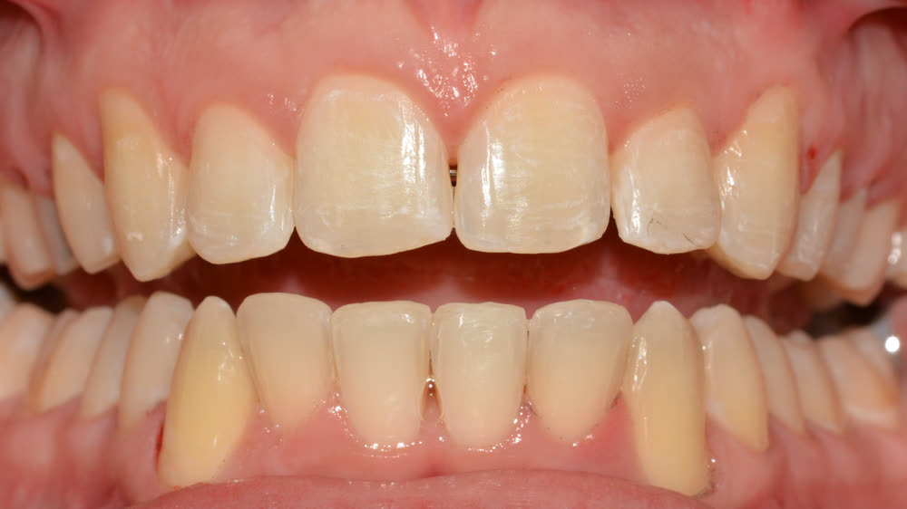 Case 11: after