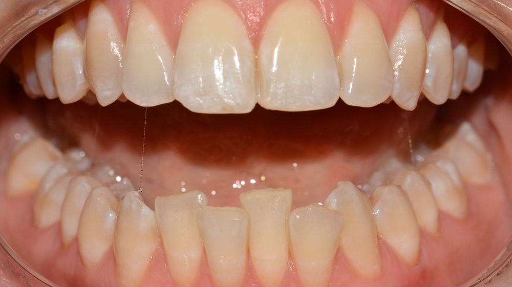 Case 12: before