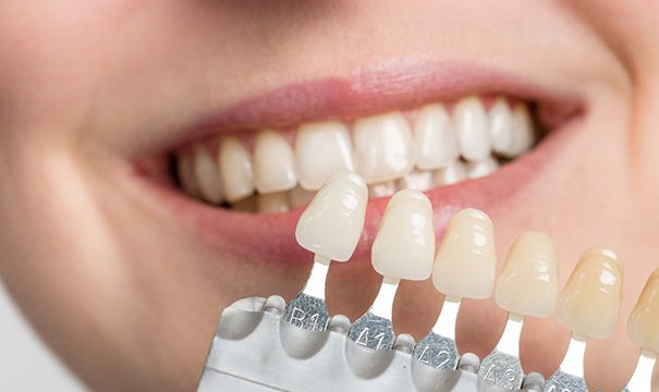 Cosmetic Bonding