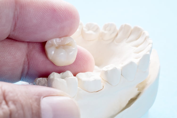 Crowns, Bridges & Veneers