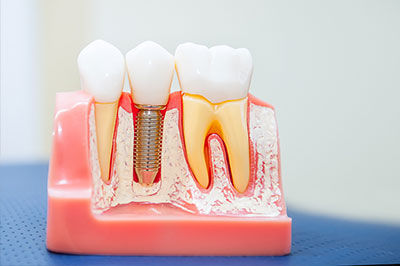 Implant Placement
