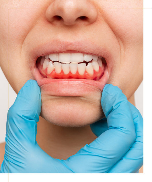 Treatment of Gum Disease