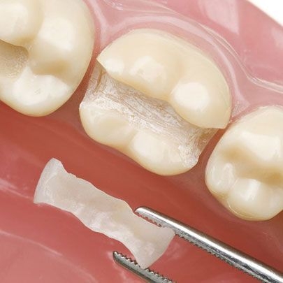 Replacement of Old Fillings