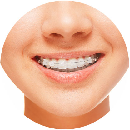 Teeth Straightening