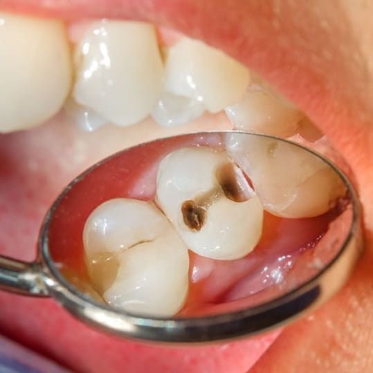 Treatment of Tooth Decay
